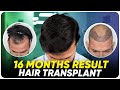 Hair transplant in india  best results  cost of hair transplant in india