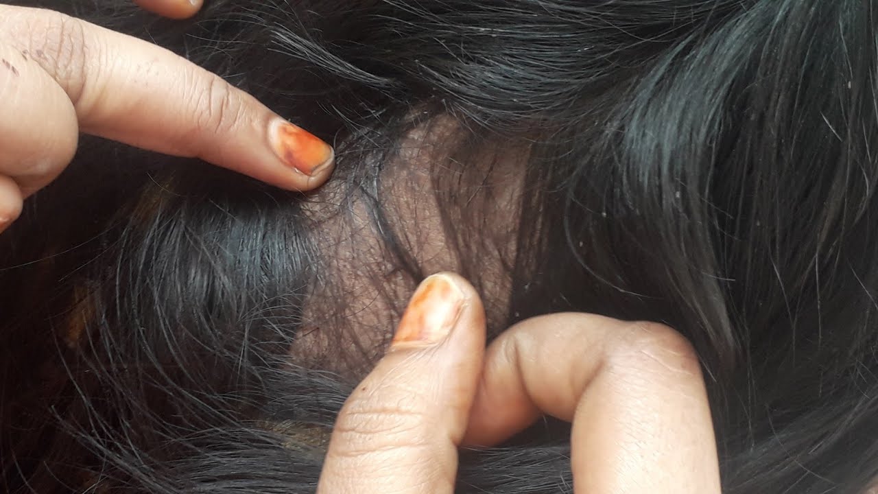 Heavy nits in doughter hair Nitpicking with her mother hands/real sounds Nitpicking in telugu