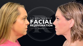Jessica’s Story: Facial Rejuvenation 1 to 9 Months Post-Op