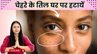 Chehre ke til ka ilaaj | How to remove Moles permanently | Skincare Remedies | Upasana ki Duniya