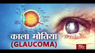 Ayushman Bhava : काला मोतिया | Glaucoma