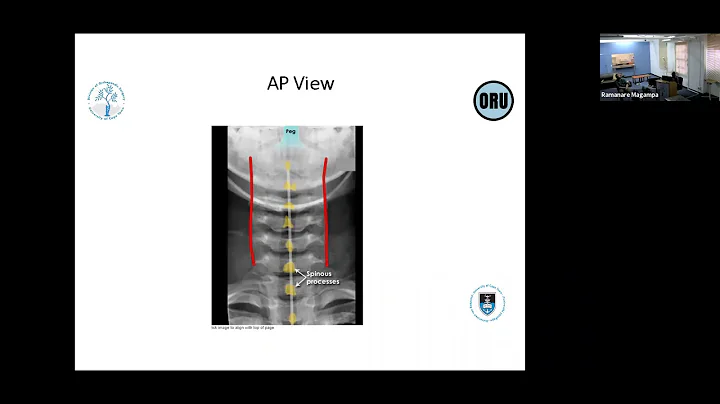 Ramanare Magampa- Practical approach to spine trauma