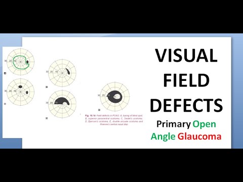 Ophthalmology 236 c Visual Field Defects POAG Primary Open Angle Glaucoma Treatment Laser Surgery