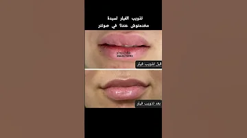تذويب الفيلر لسيدة مخدماتش عندنا في صونتر 0663175991 Meknes اكسبلور مايكاب تجميل Lips مكناس 