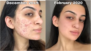 THIS PRODUCT CLEARED MY CYSTIC ACNE IN 60 DAYS