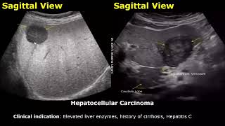 Liver Ultrasound Reporting | Liver Diseases Scan Reports | How To Write USG Report | Abdominal USG