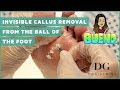 Invisible callus removal from the ball of the foot and my shoe story!