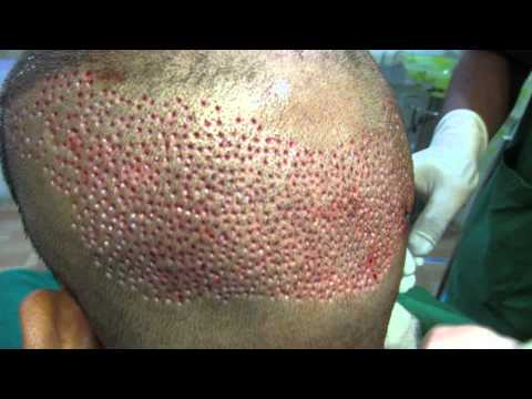 Agree, this Hair plugs trypophobia are Fantasy Hair plugs trypophobia