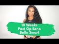 Sono Bello 10 Week Update! Incisions , Revisions and Small Concerns!