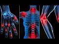 Rheumatoid Arthritis - Morphic and Vibrational Fields
