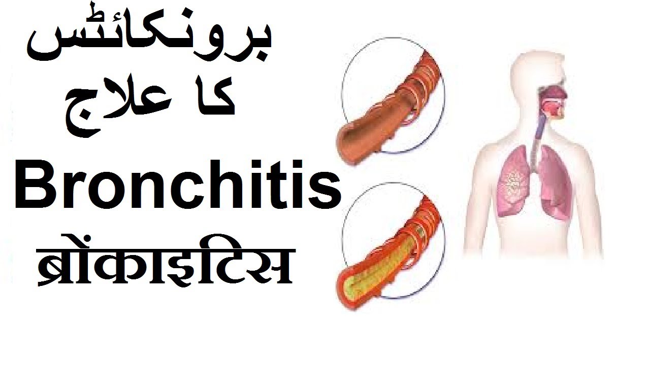 ब्रोंकाइटिस का इलाज Bronchitis treatment in Urdu, hindi برونکائٹس کا علاج YouTube