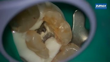 Two broken files removal from DB canal of upper first molar . Dr Adeeb Ismail