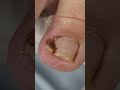 Unha encravada #usa #satisfying #shorts