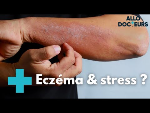 Eczéma : quelles solutions ? - Allo Docteurs