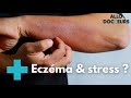 Eczma  quelles solutions   allo docteurs