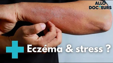 Comment eviter que l'eczéma se propage