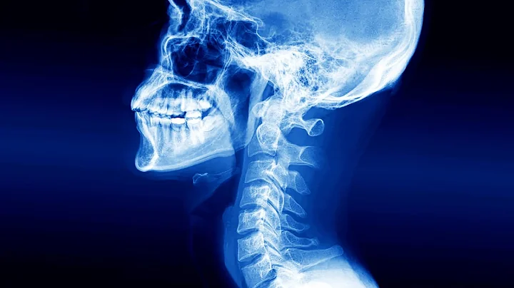 A Man Swallowed Wireless Earbud. This Is What Happened To His Esophagus. - DayDayNews