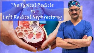 The Most Typical Left Renal Pedicle
