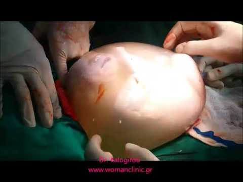 Βίντεο: Μπορεί ένα μωρό να γεννηθεί με αμνιακό σάκο ανέπαφο;