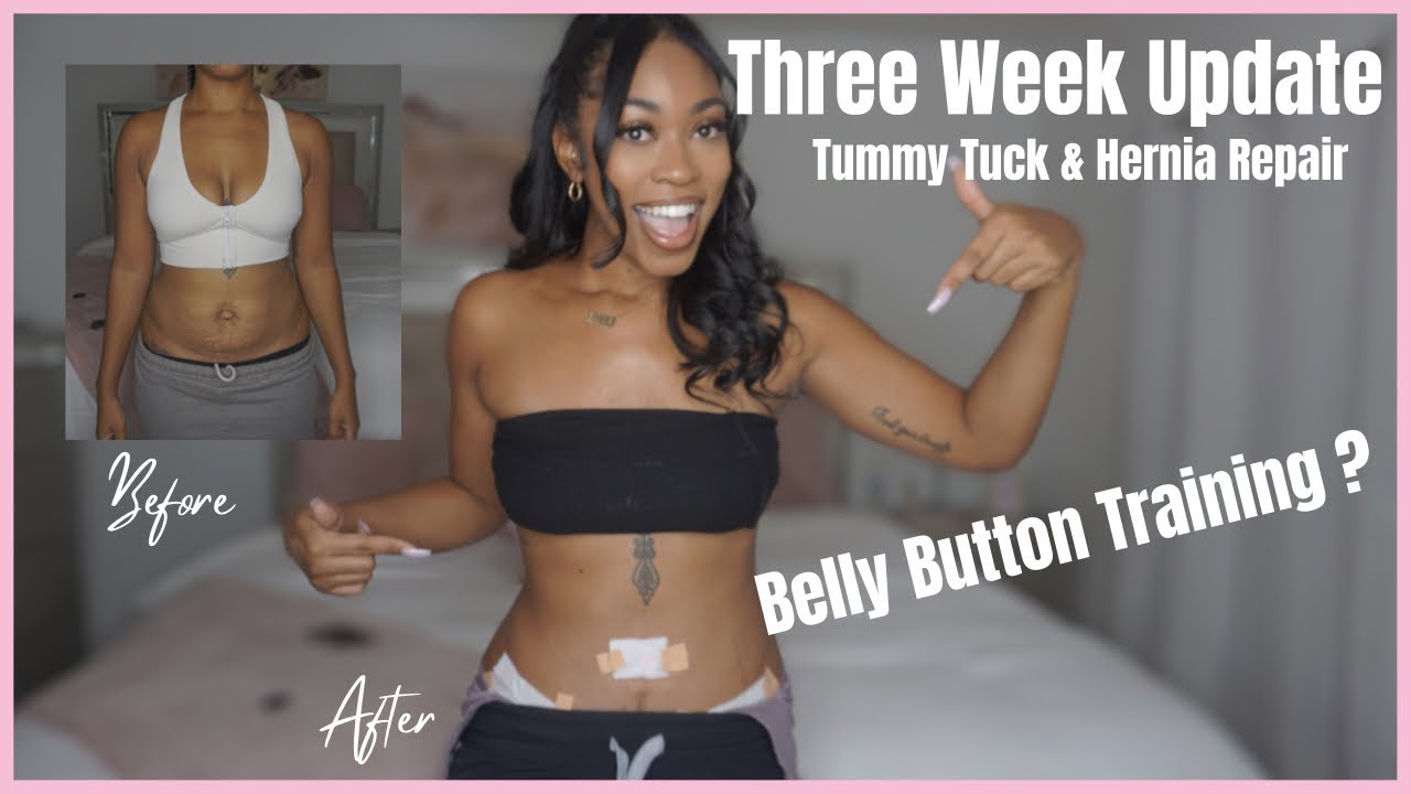 3 Week Tummy Tuck Update  belly button training 