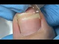 Simple toenail cutting