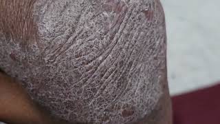 spot Diagnosis the skin condition
