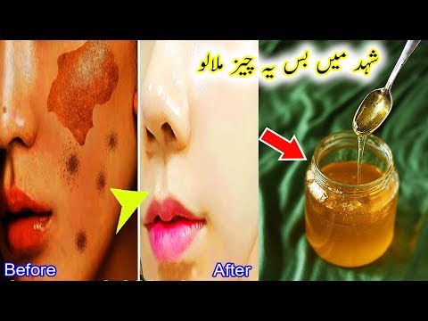 How To Remove Dark Spots With Honey - Get Rid Of Acne Scars Permanently - % Effective Remedy