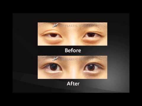 Пластическая хирургия в Корее ~ До и после ~ Plastic Surgery in Korea ~ Before and After Пластическая хирургия в Корее ~ До и после ~ Plastic Surgery in Korea ~ Before and After