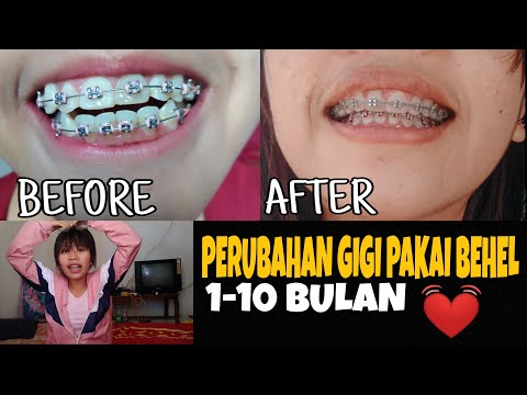 Perubahan Gigi Tonggos 1 10 Bulan Pakai Behel Gigi Kawat Gigi Cerita Pengalaman Pakai Behel Youtube