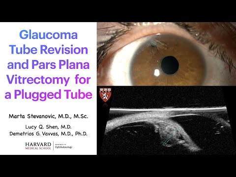 Angle closure caused by a plateau-like iris associated with an enlarged Soemmering's  ring: a case report | BMC Ophthalmology | Full Text