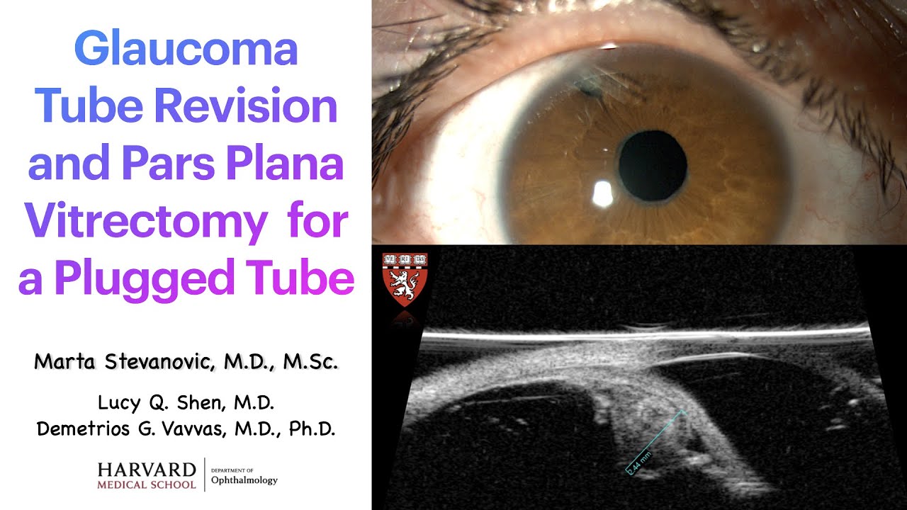 Vitreous strand clogged tube Soemmering ring cataract - YouTube