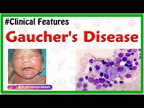 Gaucher&rsquo;s Disease: Etiology, Types, Clinical Features, Pathogenesis, Diagnosis, and Treatment