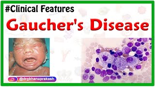 Gaucher Disease - Symptoms, Causes, Treatment