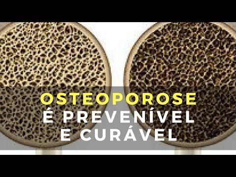 Osteoporose É Prevenível e Curável