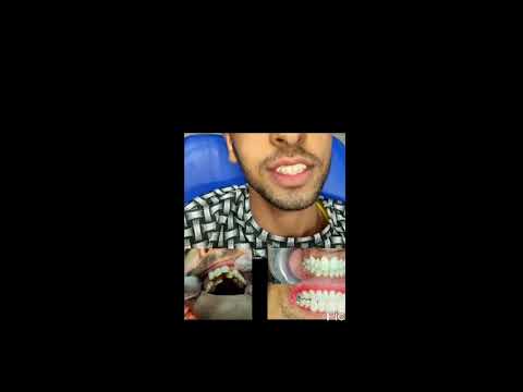 أحد حالات التقويم فى مركز الدكتور أشرف شرف تقويم الاسنان بالتقسيط واسعار مناسبه