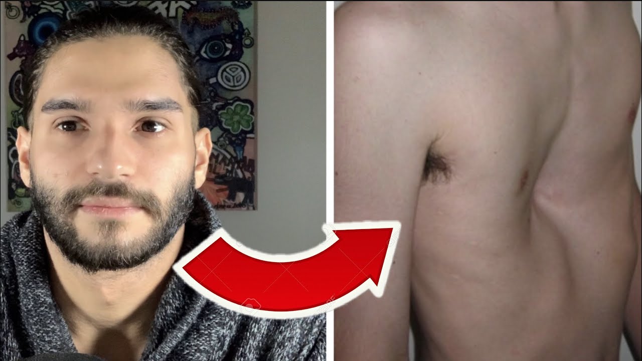 ASMR FRANÇAIS | MON PLUS GROS COMPLEXE … Pectus Excavatum