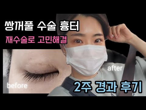 쌍수 후기 | 쌍꺼풀수술 경과👀 | 쌍꺼풀재수술+눈매교정+앞트임 | 2주 성형 브이로그 | 쌍수 브이로그 - YouTube
