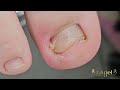 #satisfying #ingrowntoenail