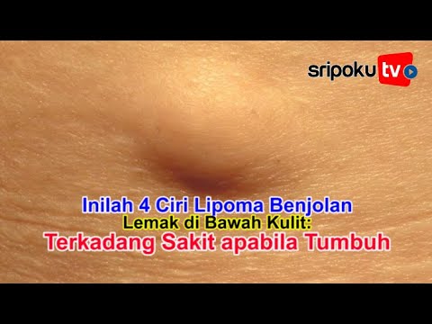 Video: Lemak Di Kaki - Penyebab, Gejala Dan Pengobatan