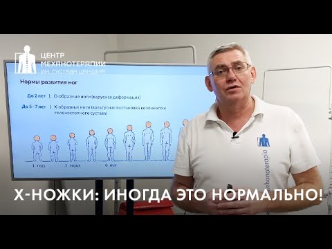 Видео: Можно ли исправить искривление ног у детей?