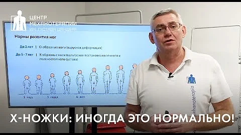 Вальгус ног (Х-ножки): когда это нормально и 