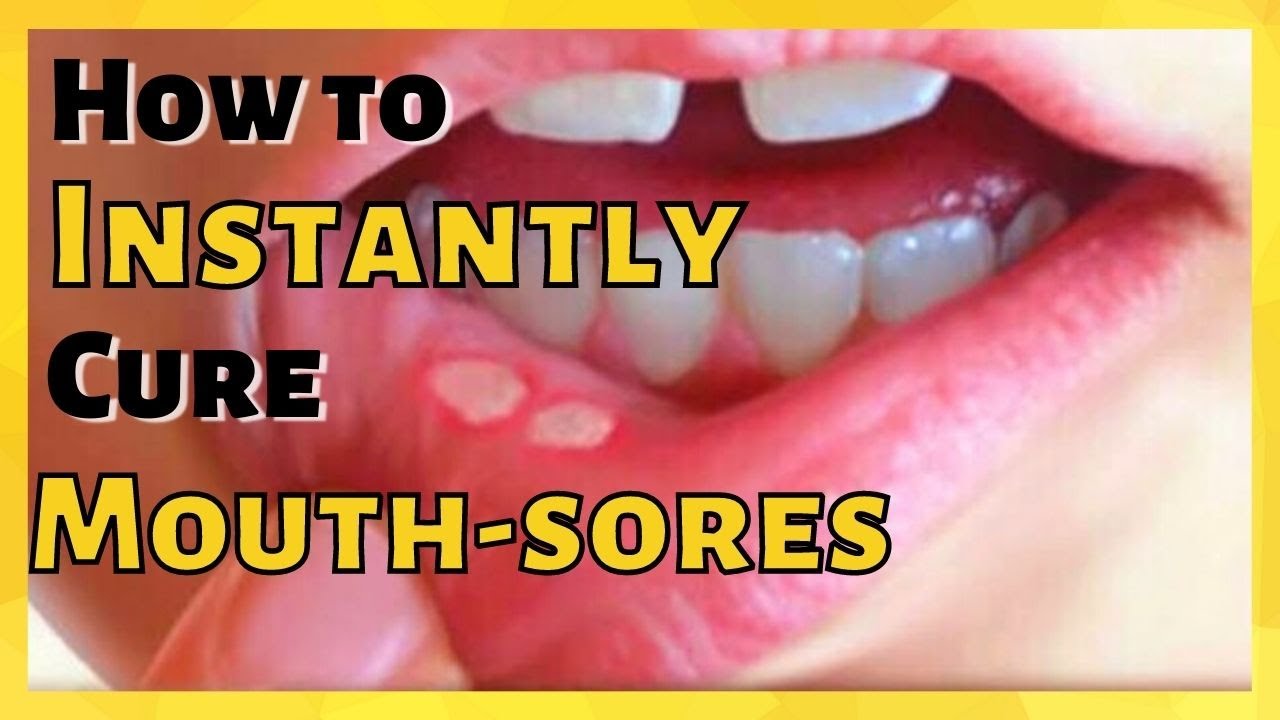 How to Cure Mouth Sores INSTANTLY! Benefits of Kattha (Catechu) Be