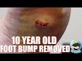 HE HAD THIS STUCK IN HIS FOOT FOR 10 YEARS ***MYSTERY BUMP REMOVAL***