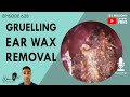 628 - Gruelling Ear Wax Removal