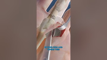 Trigger Finger Release (3D Animation)