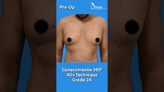 Male Breast Reduction Surgery Result Grade 2A | Gynecomastia Surgery with 360° Resimi