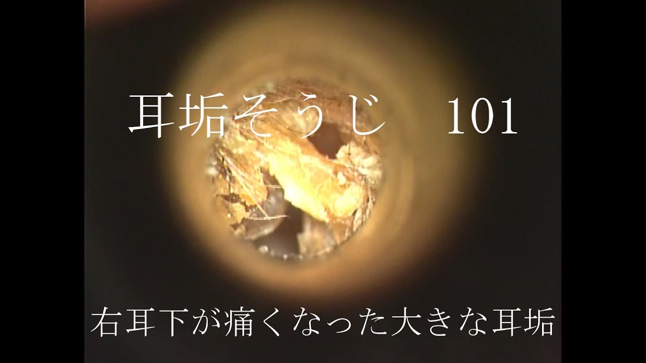 耳垢そうじ 右耳の下が痛くなった大きな耳垢 101的youtube视频效果分析报告 Noxinfluencer