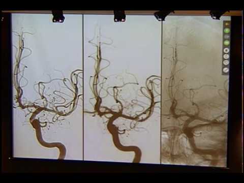 Interventional Neurology 7/18/17