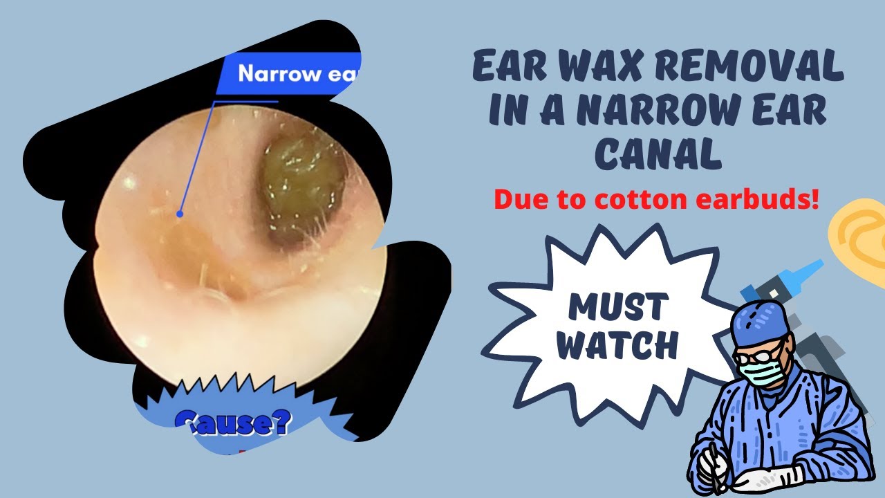 Episode 1 Ear wax removal narrow ear canal, due to Qtips/cotton ear