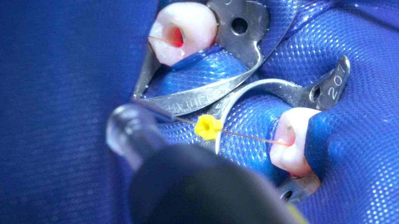 Root canal disinfection with SIROLaser Blue YouTube